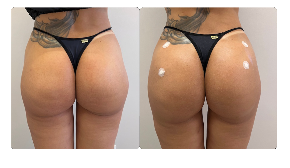 Antes e depois de harmonização glútea